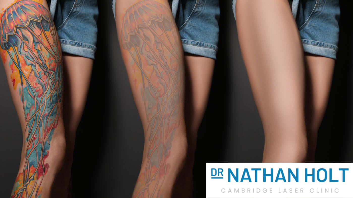 Cambridge Laser Clinic - Laser Tattoo Removal