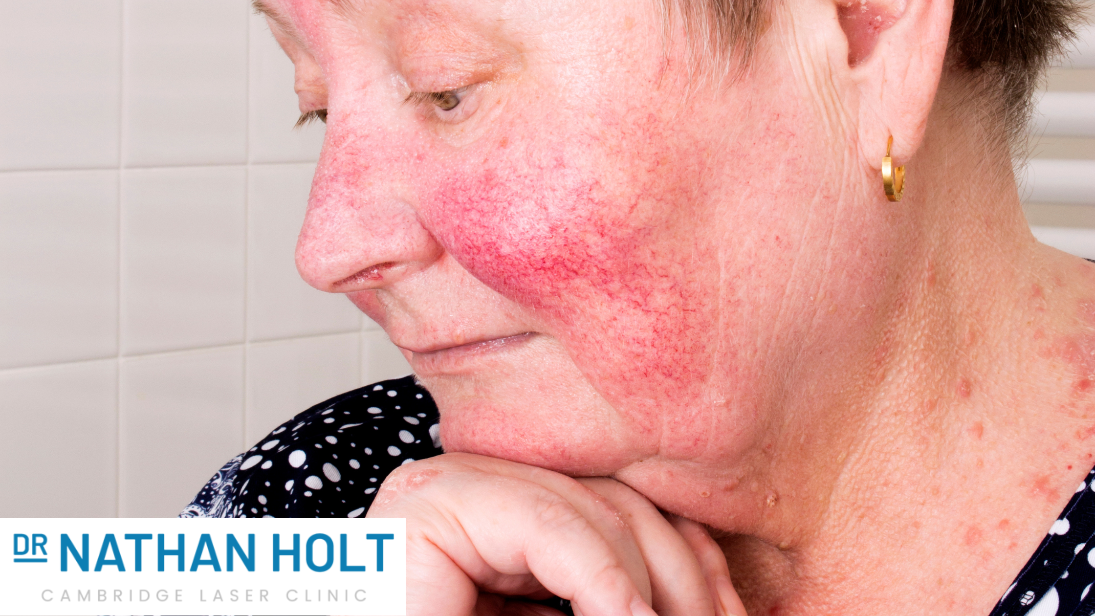 Rosacea - Not Just For April