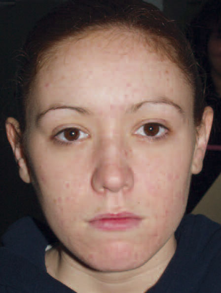 Acne After Treatment