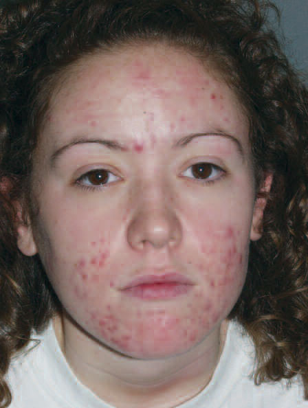 Acne Before Treatment