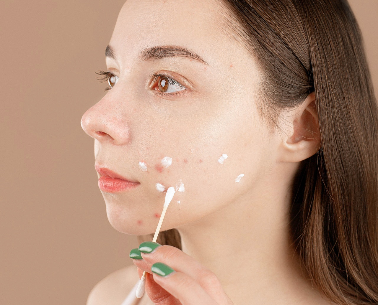 person applying cream to acne