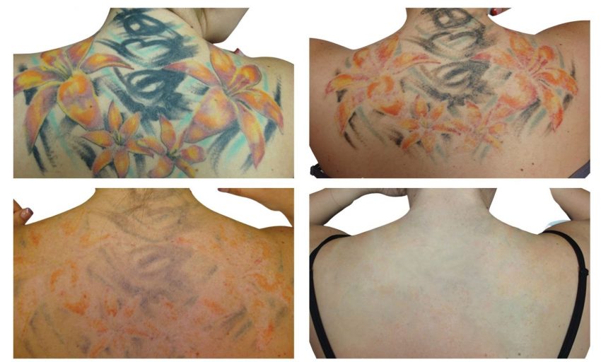 4 stages of tattoo removal in 4 images
