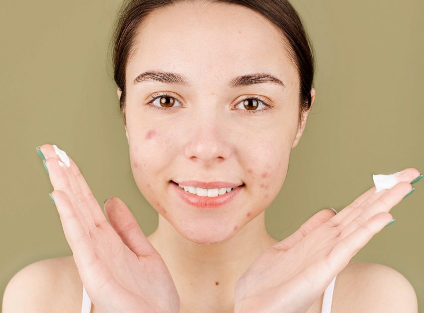 person with acne faces camera with a smile, cream on fingers ready to apply, choosing the right body wash for acne-prone skin