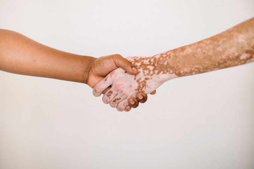 shaking hands, one with pigmentation problems