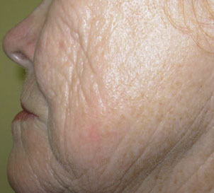 Fine Lines and Wrinkle Reduction Before