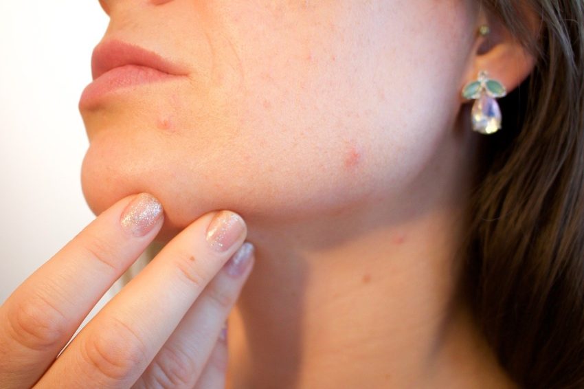 closeup of person's chin and cheek, acne sufferer ready to use salicylic acid, how to