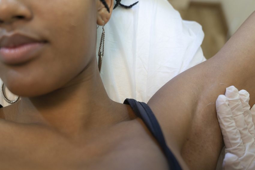 closeup of person about to receive laser hair removal under arm