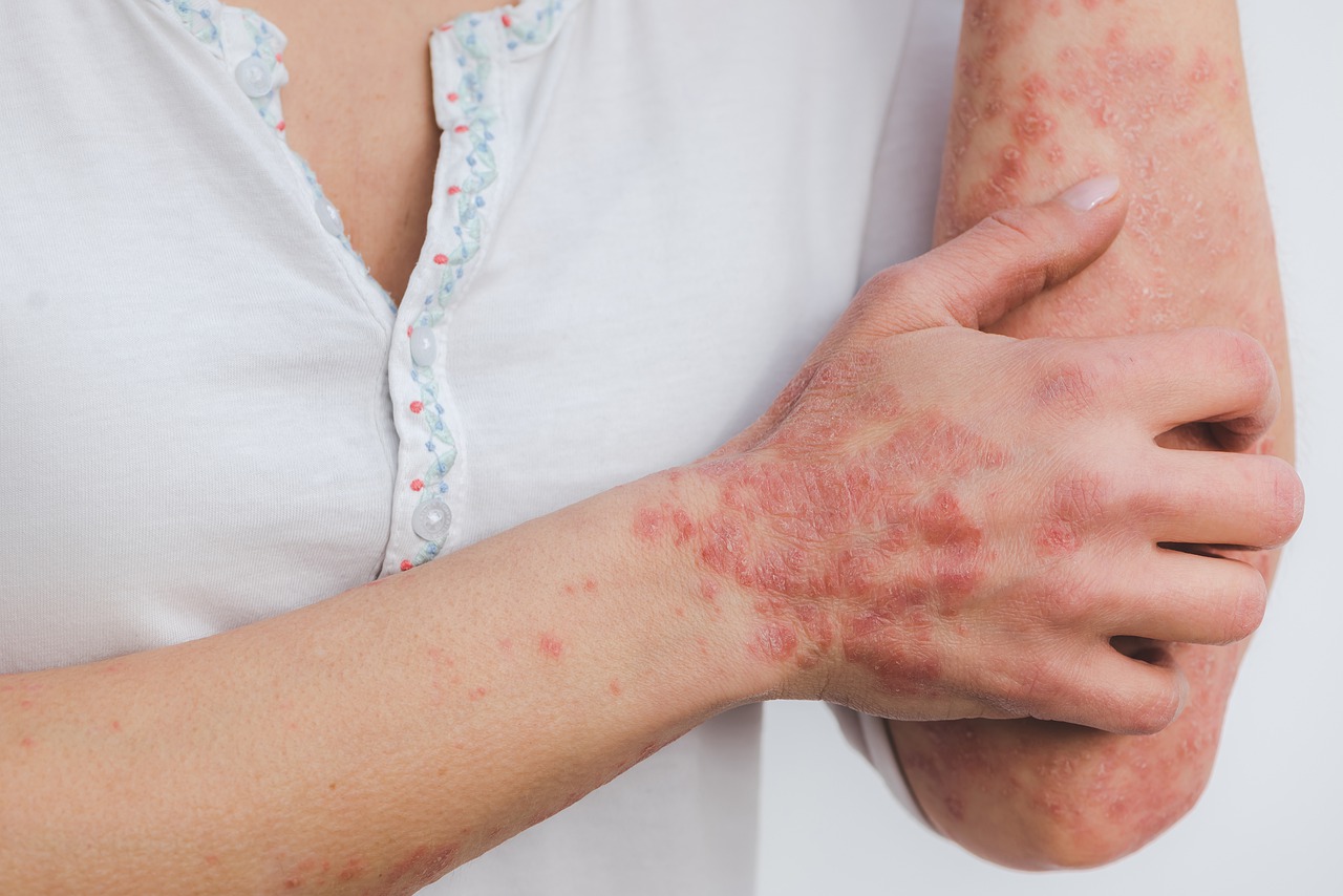 closeup of person with psoriasis scratching the skin on their arm