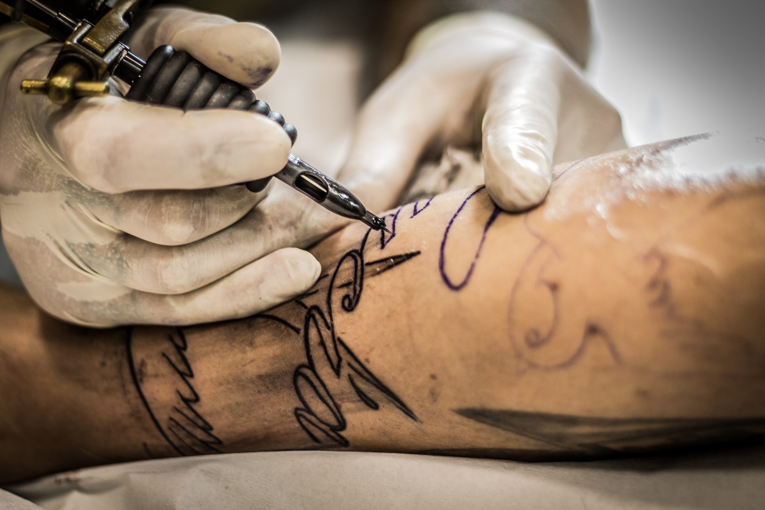 10 Things to Know Before Starting Laser Tattoo Removal - Dr Nathan Holt