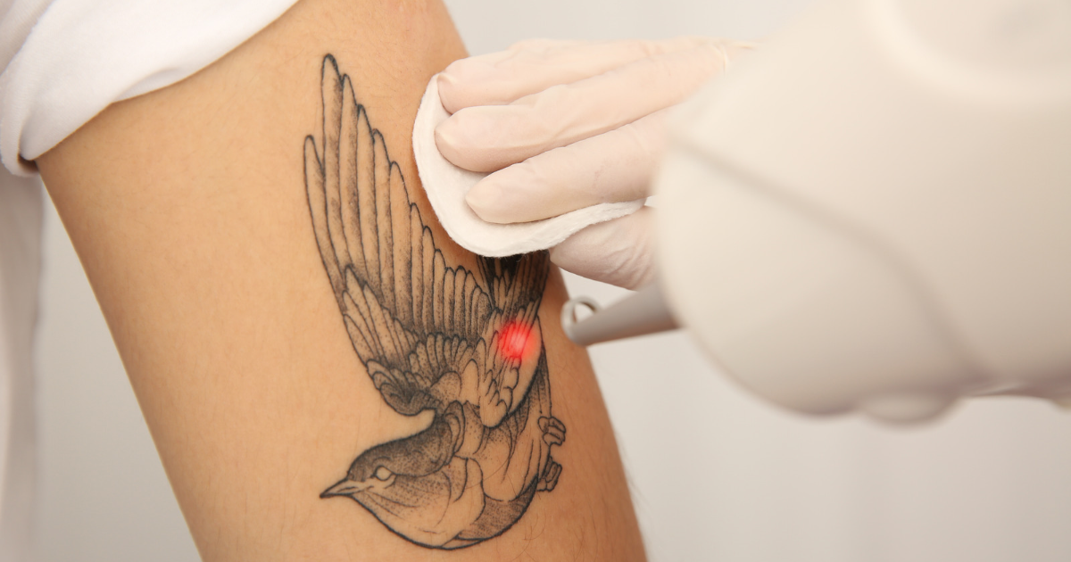 Tattoo of a bird on an arm being removed by laser
