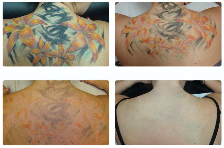 An Idiot's Guide to Laser Tattoo Removal - Dr Nathan Holt