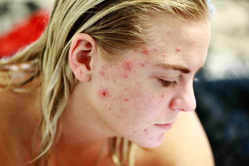 woman with acne, scars, looks away from camera